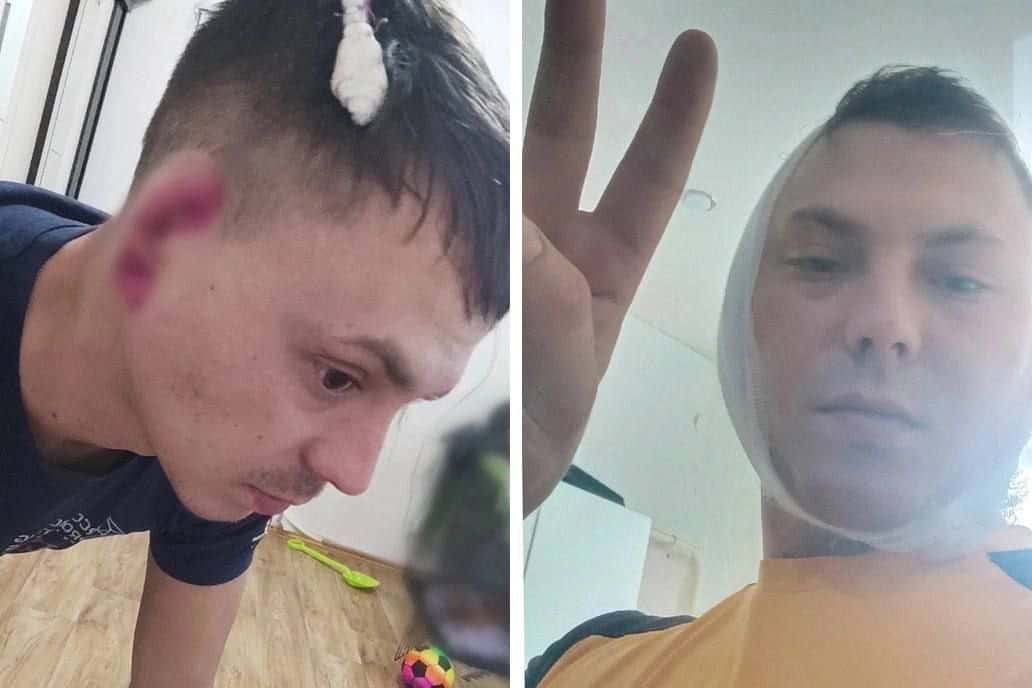 На Урале мужчине откусили ухо в пьяной драке