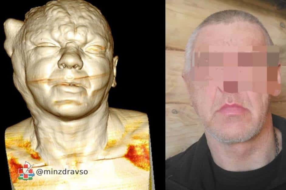 Свердловские врачи помогли трем местным жителям избавиться от дефектов внешности