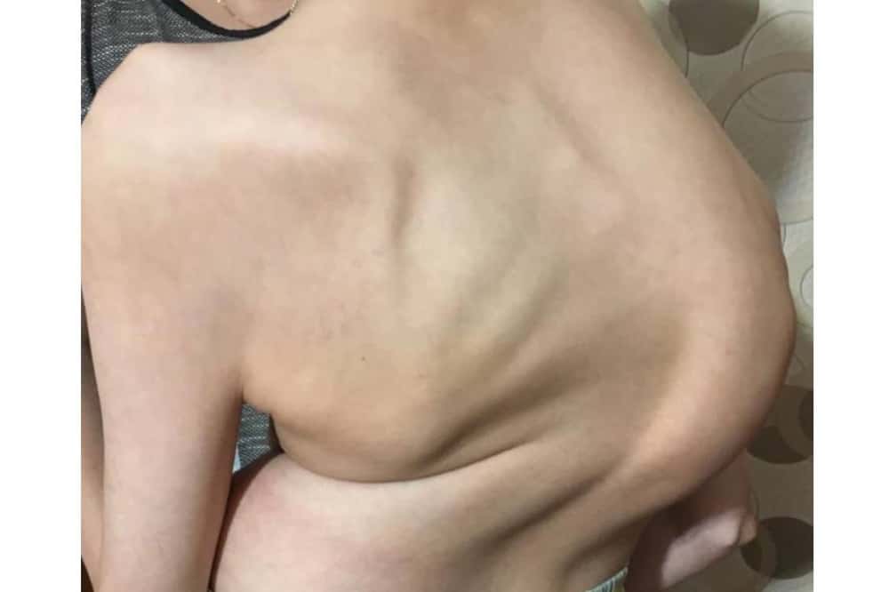 В Свердловской области врачи провели сложную операцию по коррекции сколиоза 19-летнему пациенту 