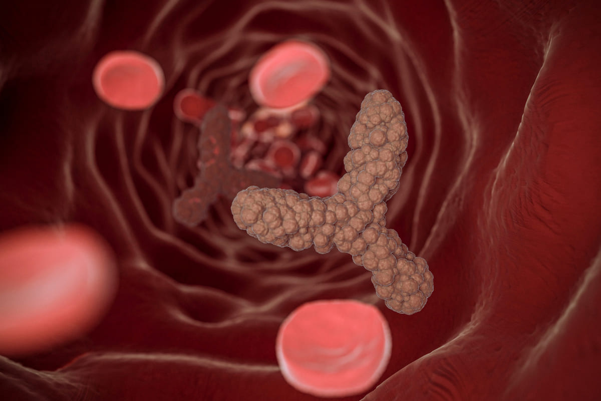 Нашли бляшку со стенозом 30%: кардиолог рассказал все про атеросклероз и что делать, если бляшка перекрыла треть сосуда