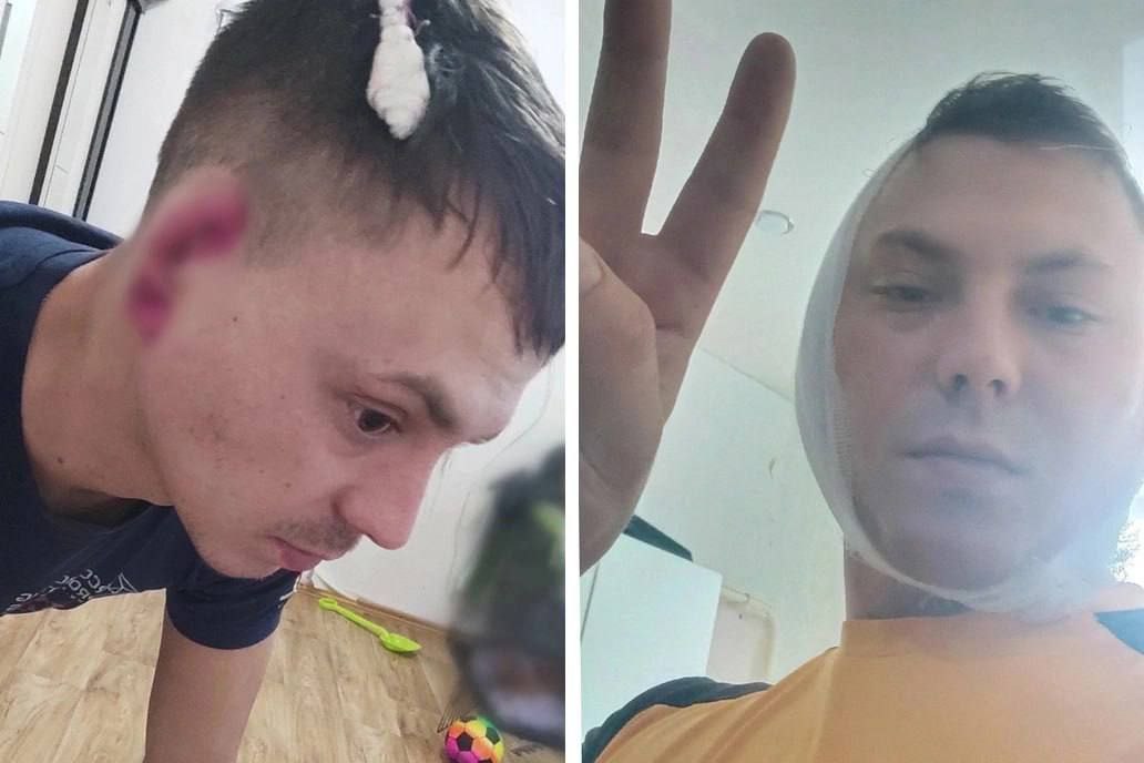 На Урале мужчине откусили ухо в пьяной драке На Урале мужчине откусили ухо в пьяной драке
